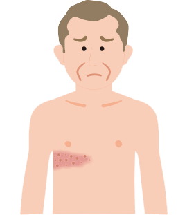 帯状疱疹の発症部位